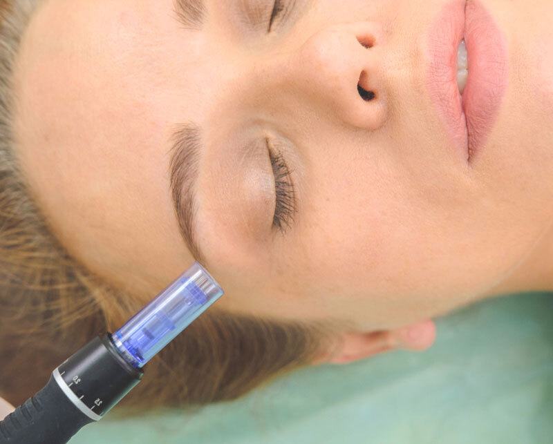 Estefanía Iñiguez, dermapen ACCGLOW facial